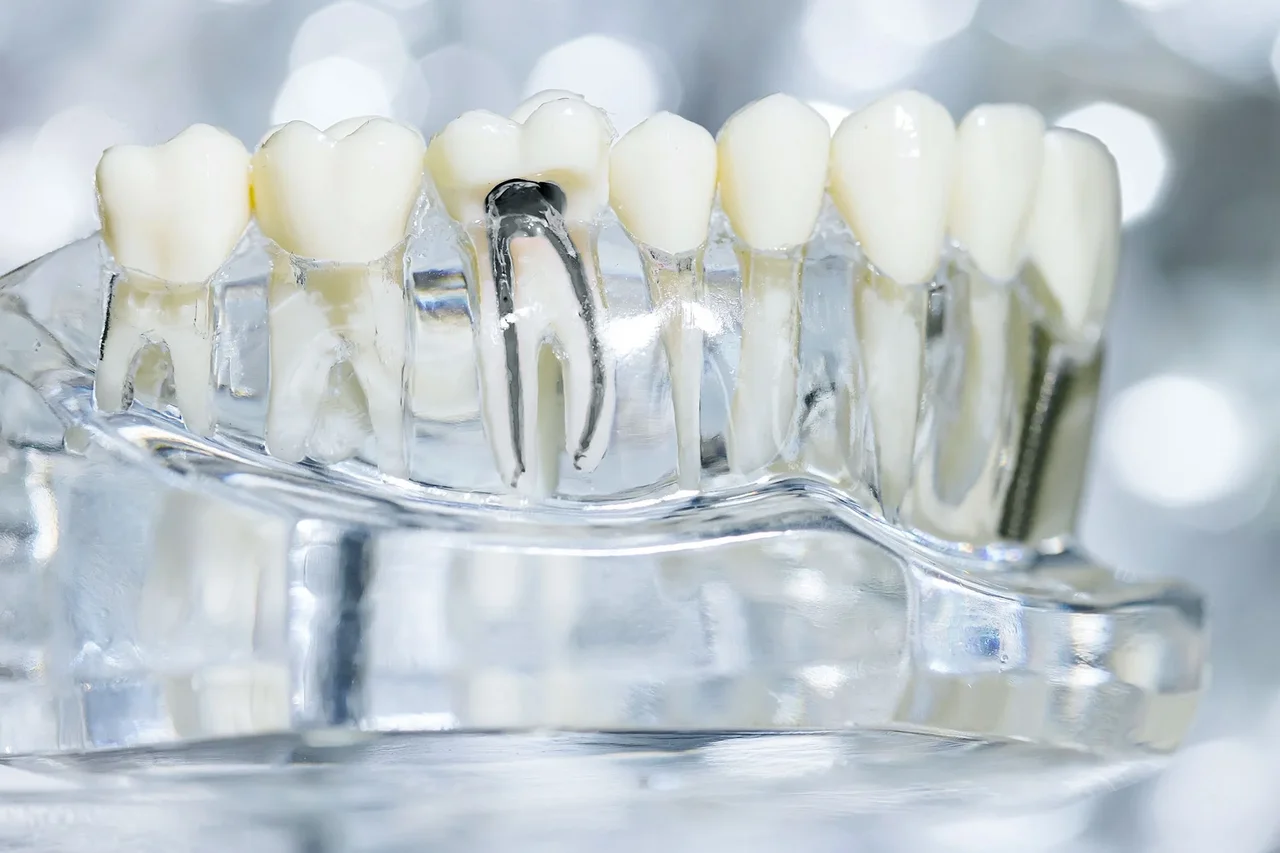 Tooth model showing a root canal treatment