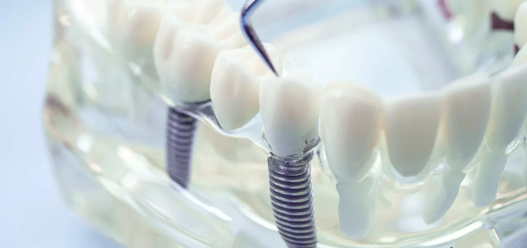 Dental implant model with an implant screw on a tooth model
