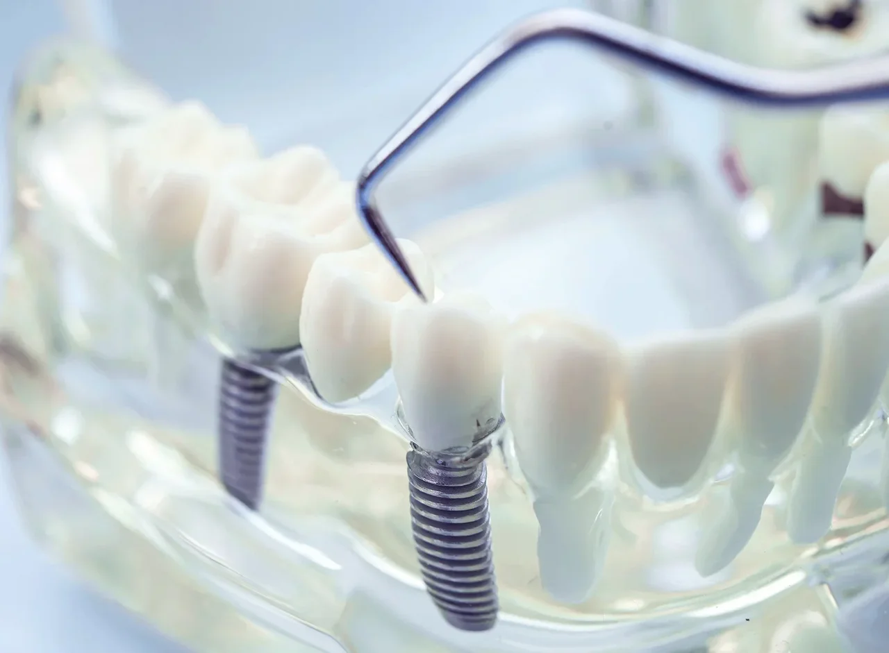 Dental implant model with an implant screw on a tooth model